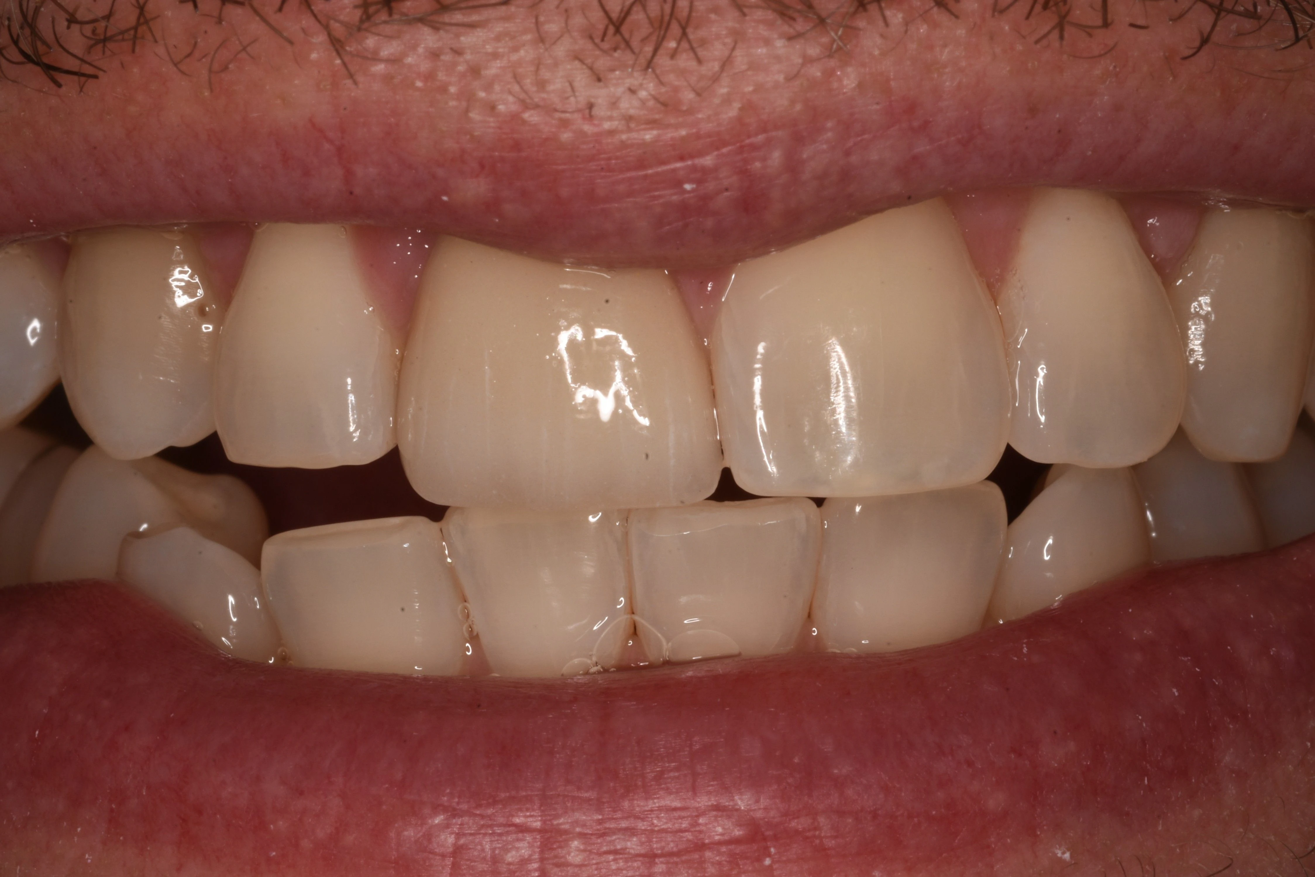 Broken Front Tooth — After