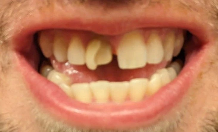 Broken Front Tooth — Before