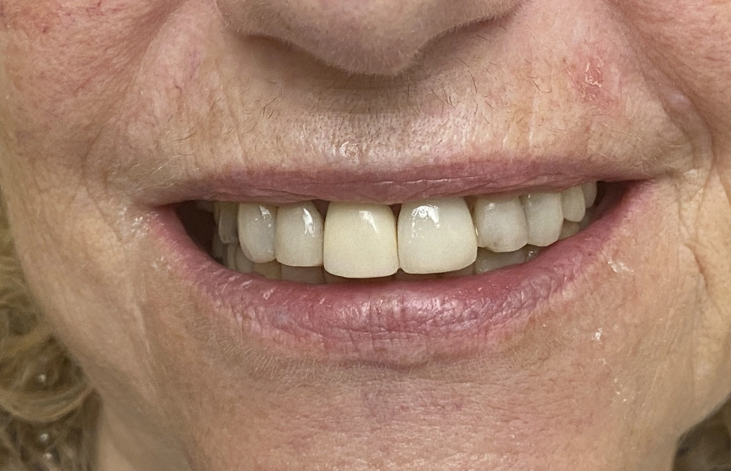 Crown Replacement — Before