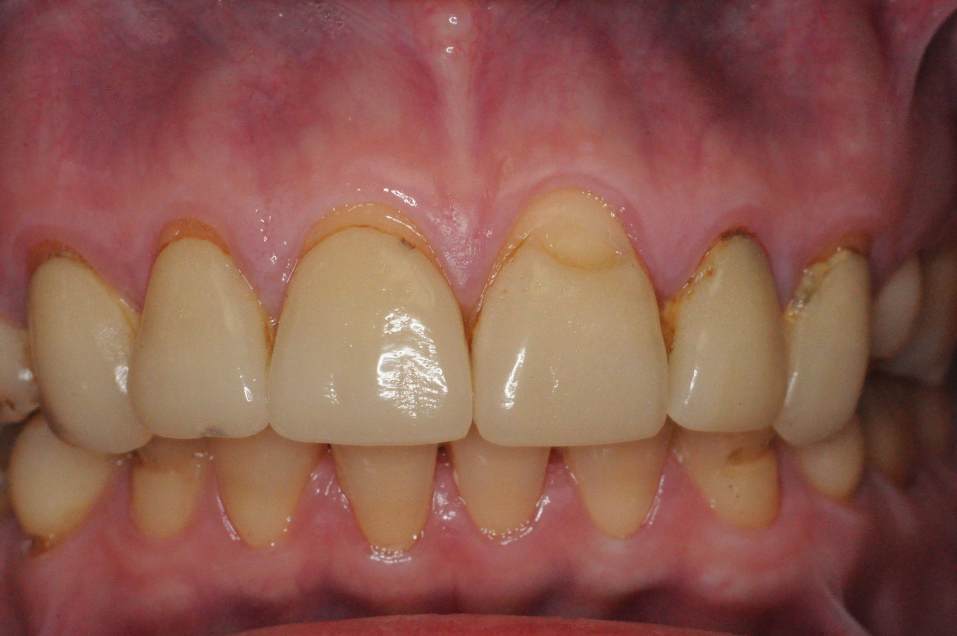 Dental Veneers — Before