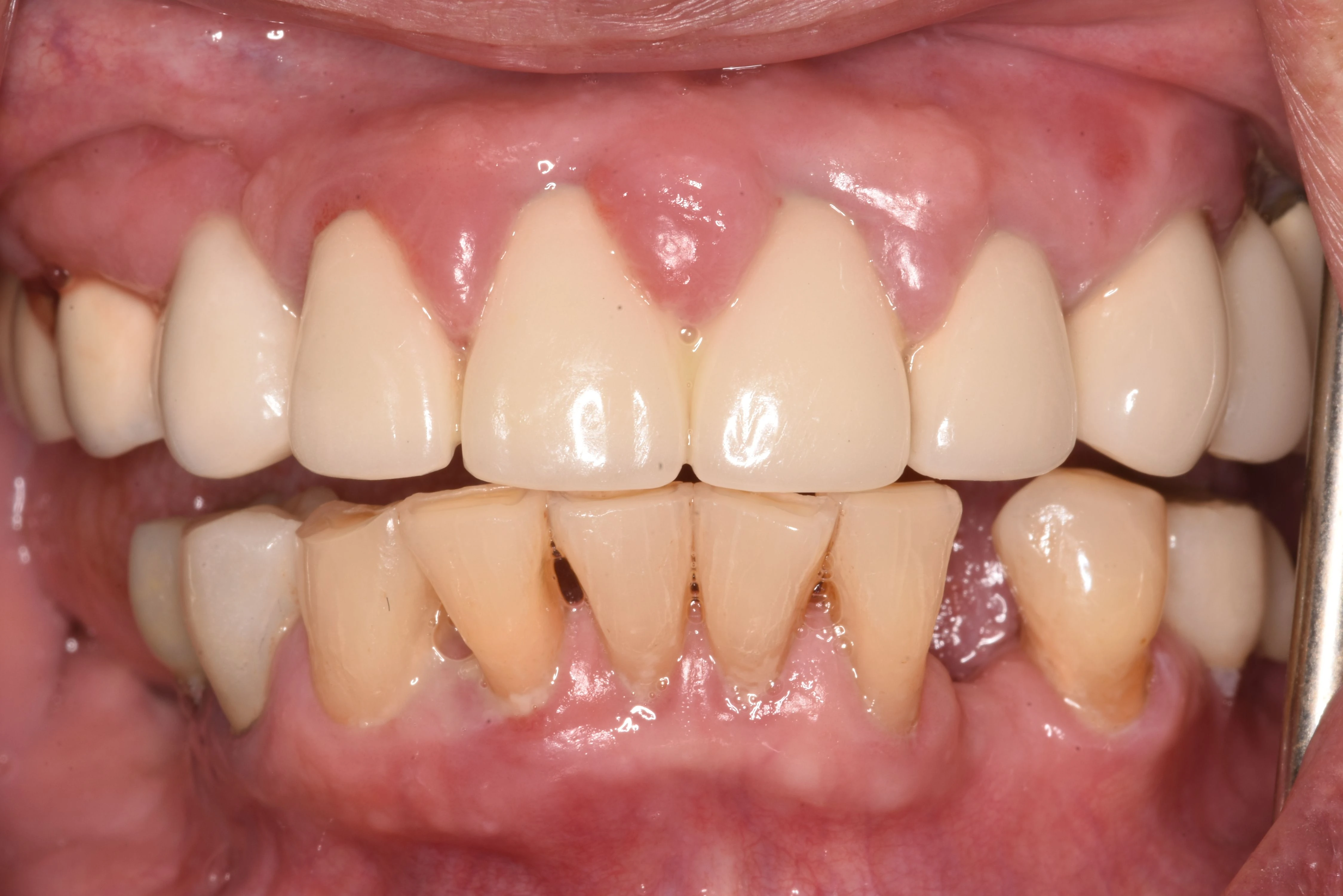 Failing Dental Work — Before