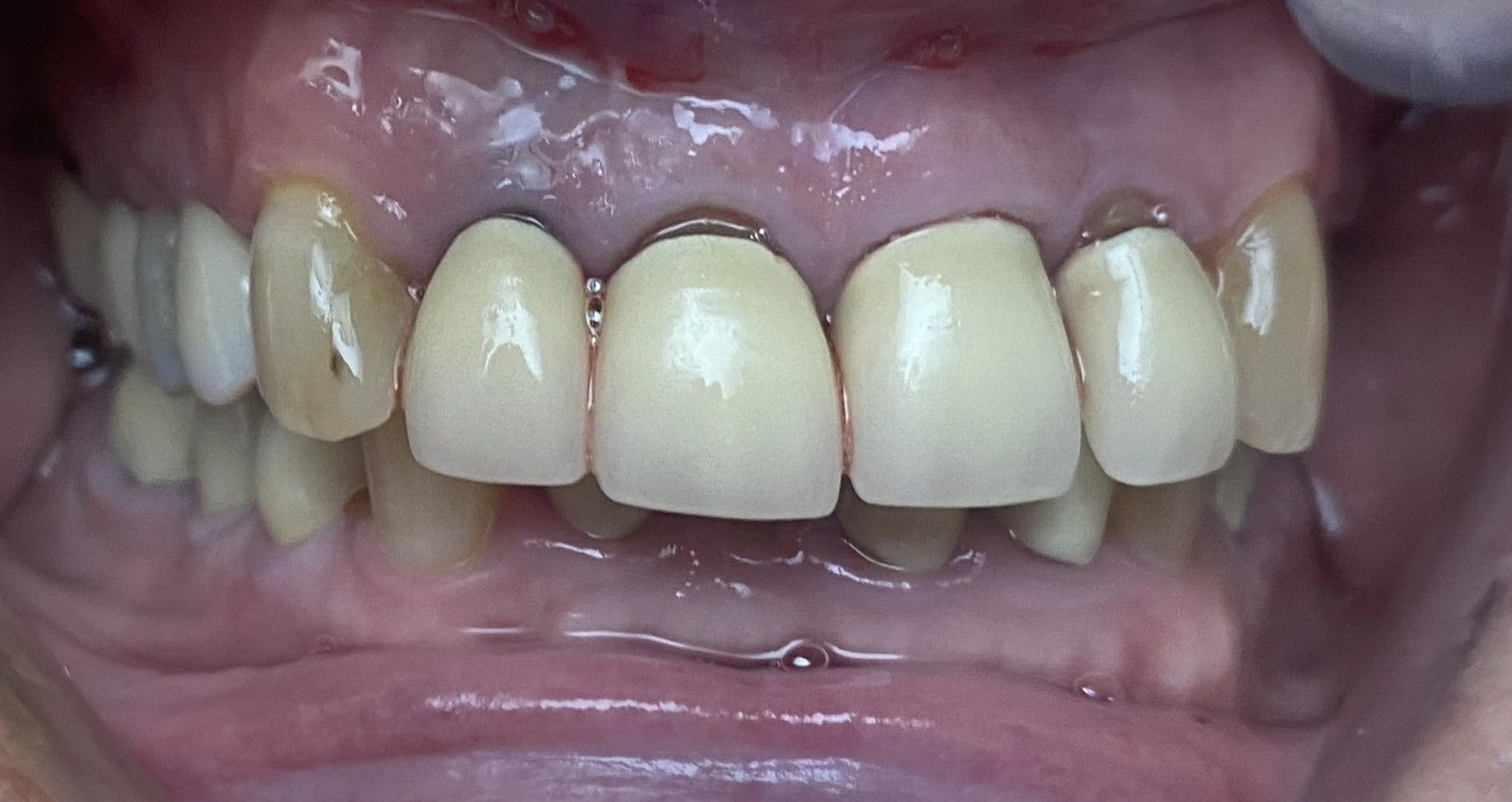 Old Crowns — Before