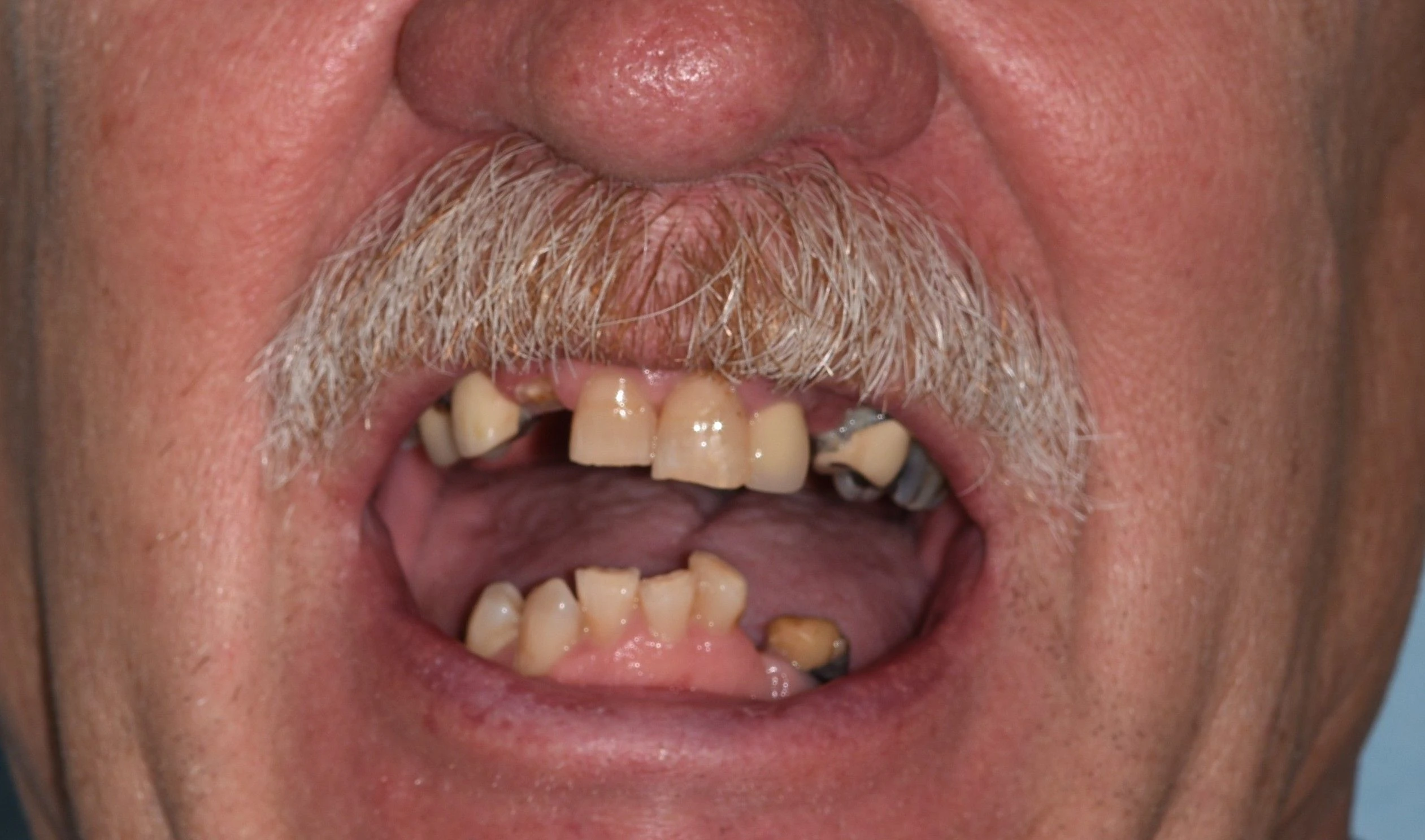 Smile Makeover — Before