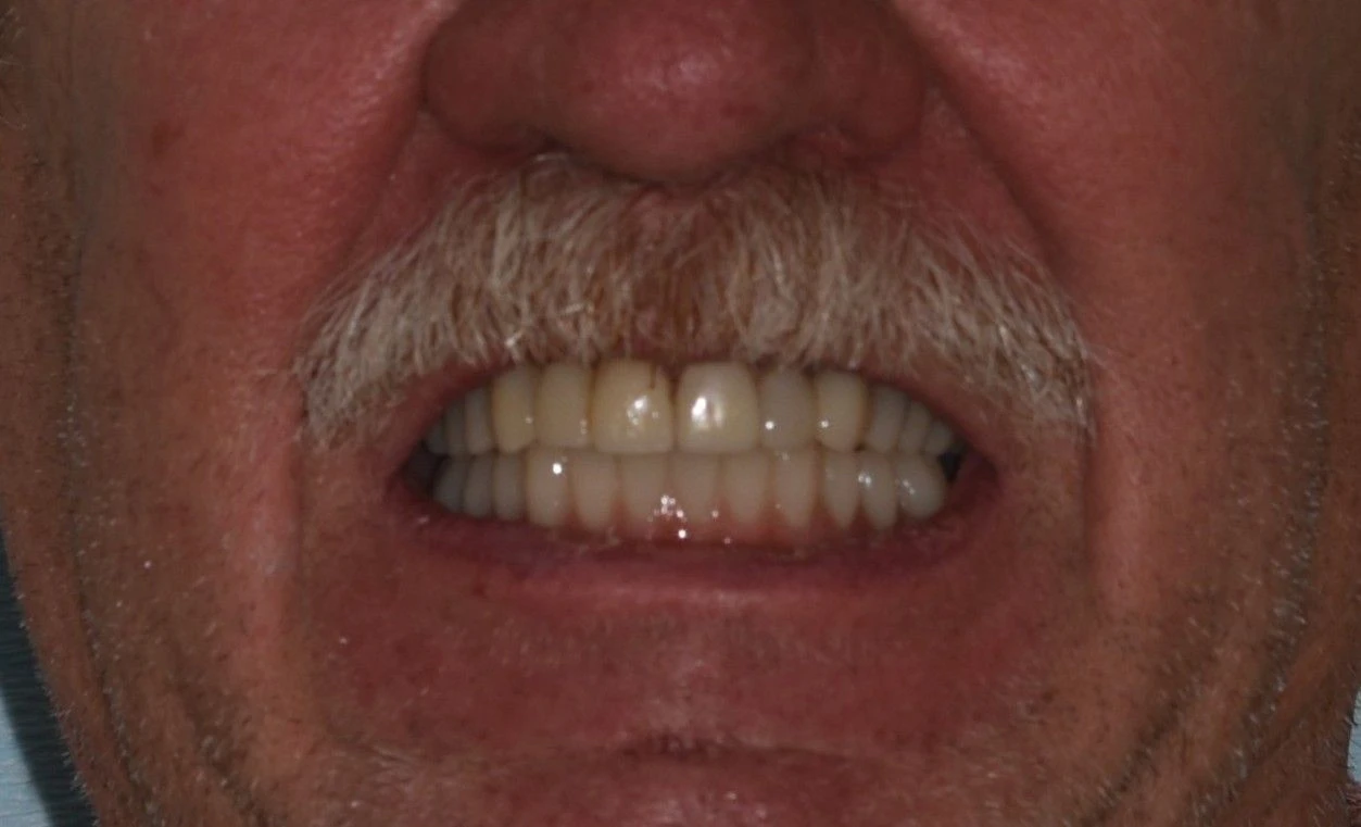 Smile Makeover — After