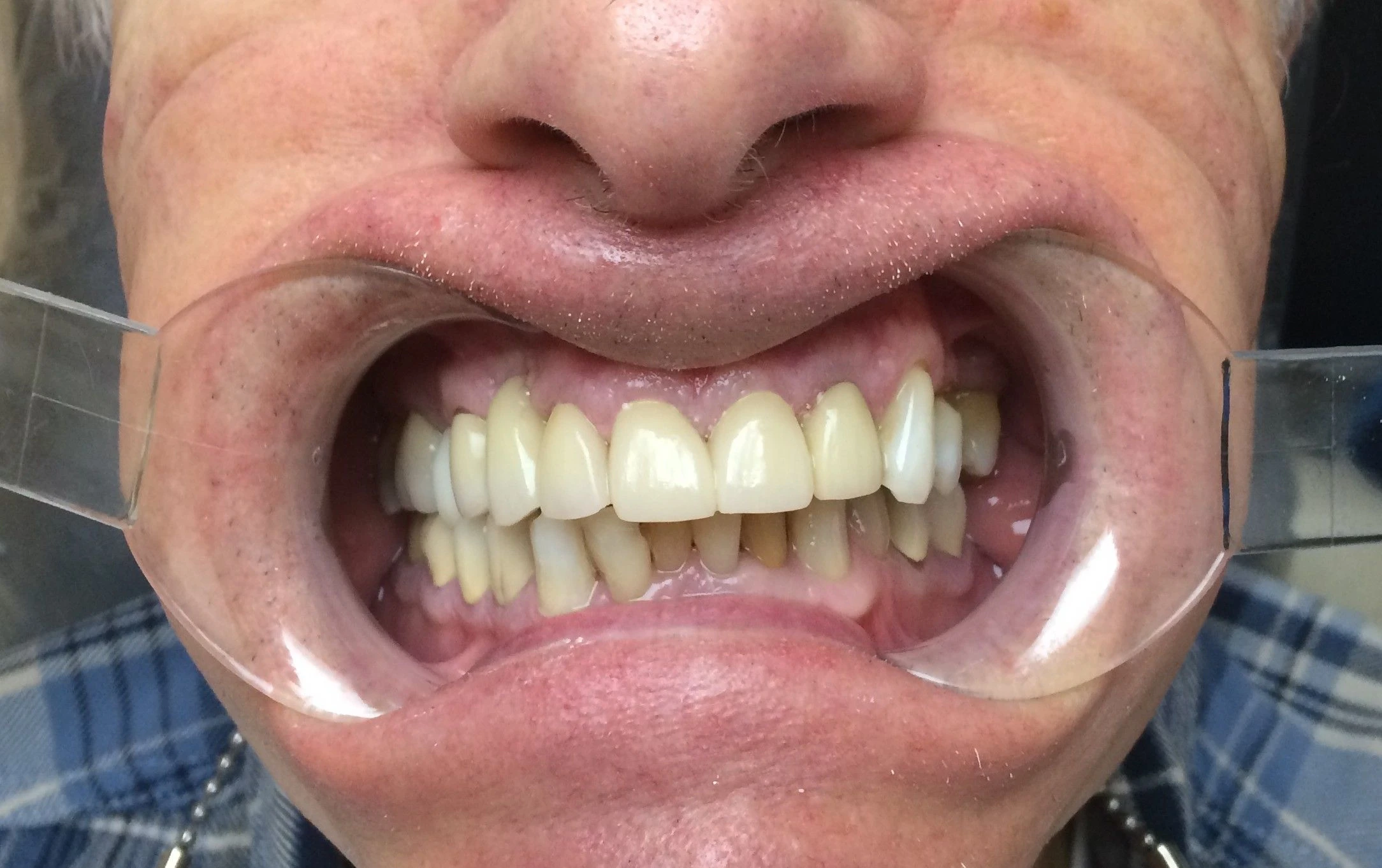 Stained Teeth — After