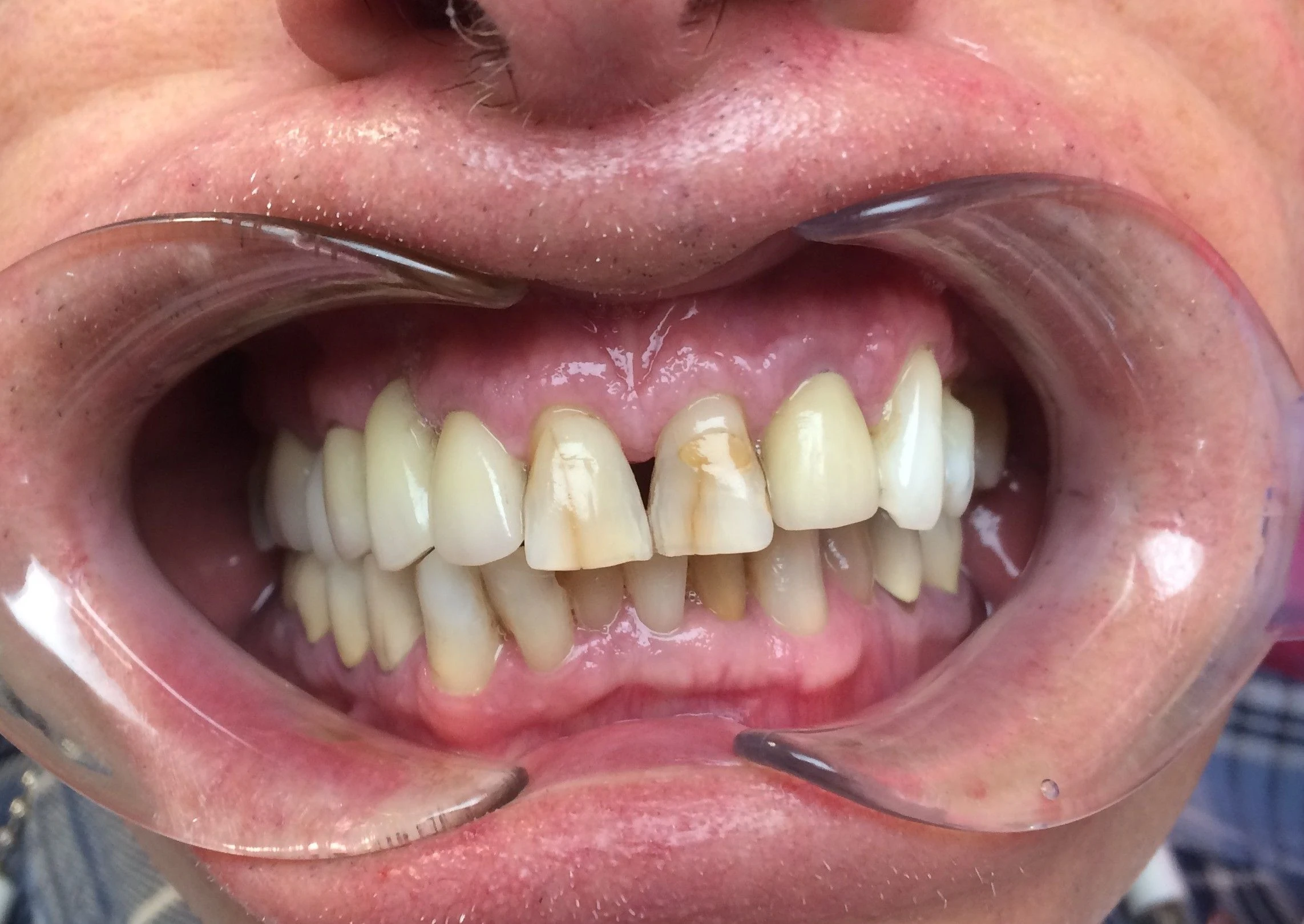 Stained Teeth — Before
