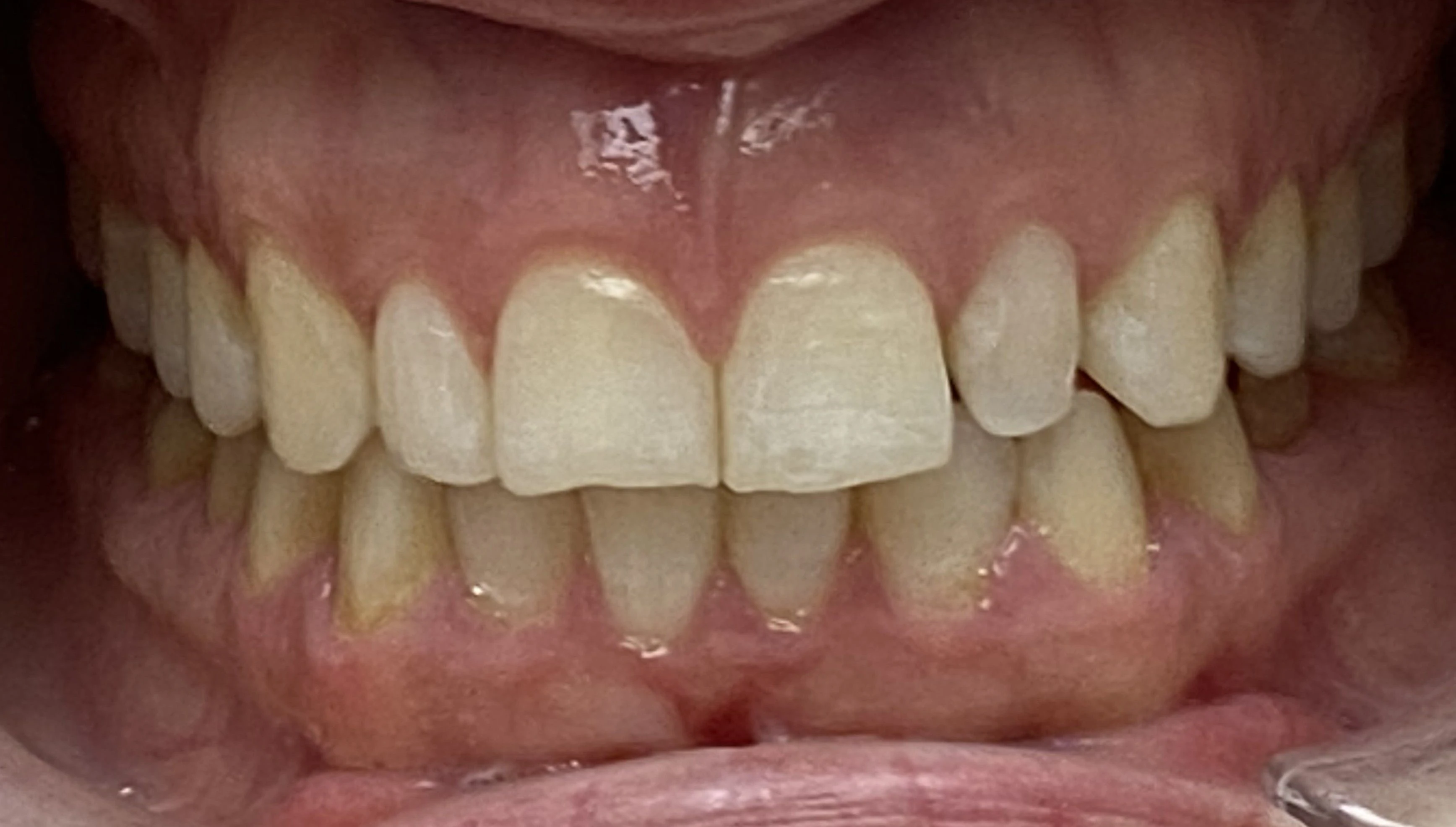 Veneers & Gummy Smile — Before