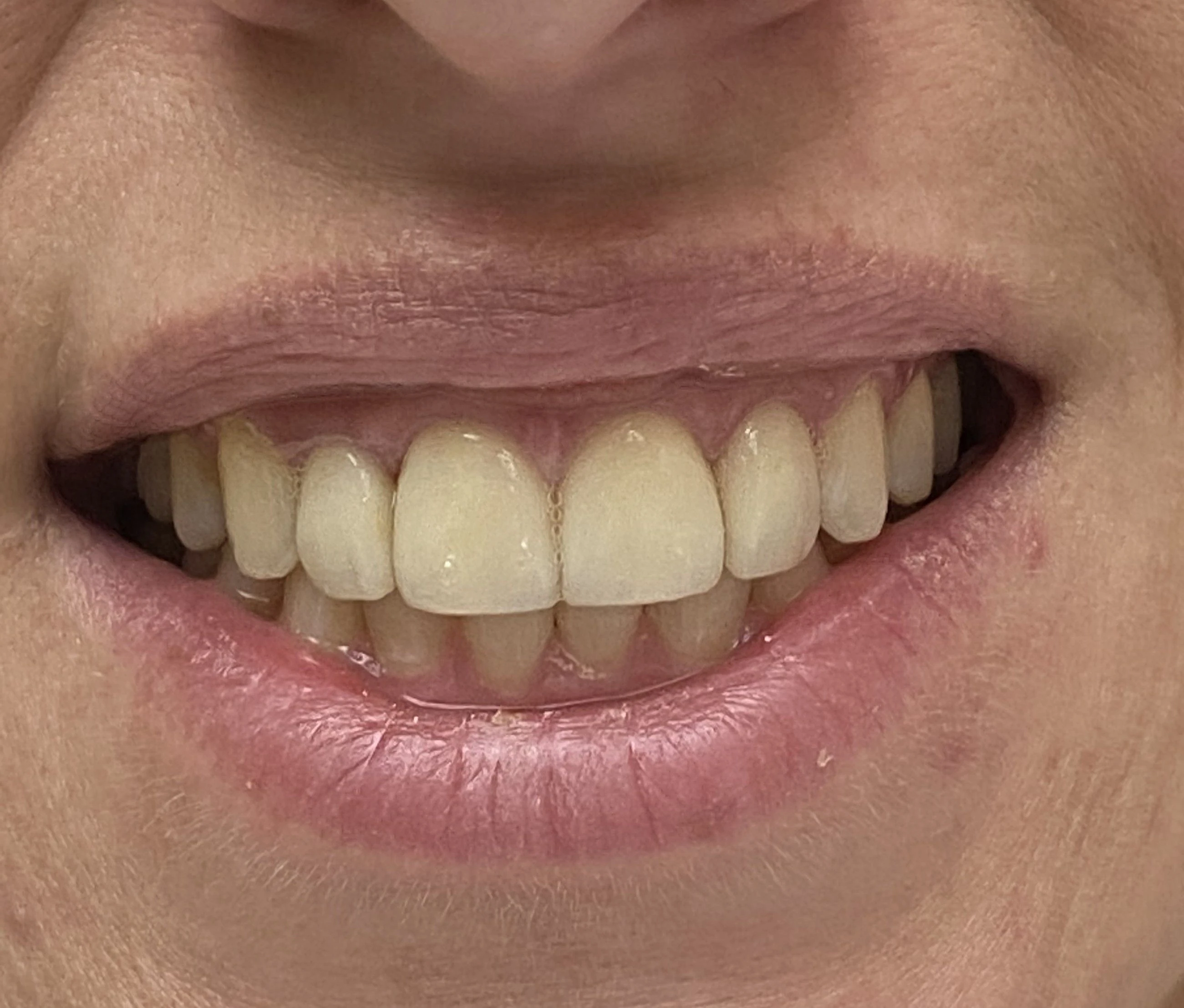 Veneers & Gummy Smile — After